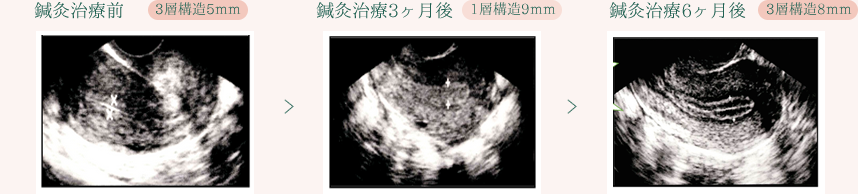 鍼灸治療経過